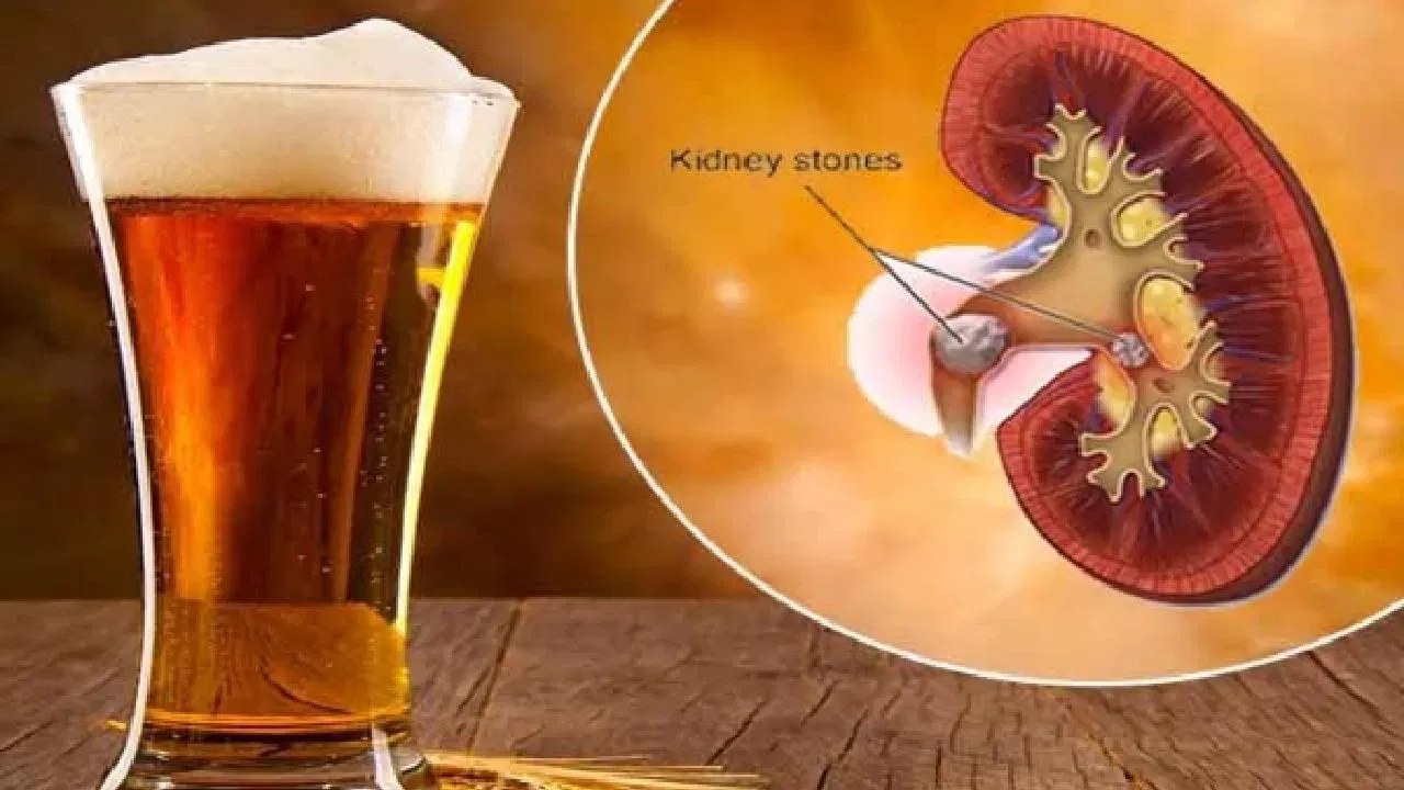 बिअर : बिअर हा किडनी स्टोनवरचा उपचार नाही. तात्पुरते लघवीचे प्रमाण वाढल्यामुळे खडा पडल्याचा भास होऊ शकतो, पण दीर्घकाळात हे शरीरासाठी नुकसानदायकच आहे. तुम्हाला असा त्रास होत असेल तर त्वरित डॉक्टरांचा सल्ला घ्या.