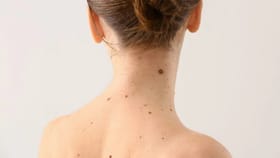 शरीरावरील अनेक तीळ धोकादायक कधी ठरतात? त्यामागील कारण घ्या जाणून.