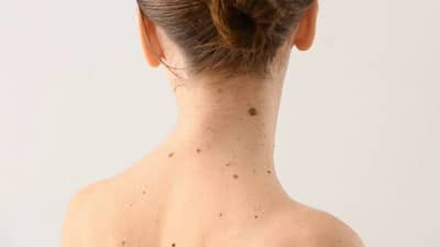 शरीरावरील अनेक तीळ धोकादायक कधी ठरतात? त्यामागील कारण घ्या जाणून