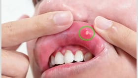 तोंडात वारंवार अल्सर होतायत? मग हे साधे फोड नाहीत, वेळीच सावध व्हा.