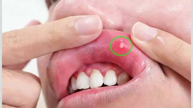 तोंडात वारंवार अल्सर होतायत? मग हे साधे फोड नाहीत, वेळीच सावध व्हा