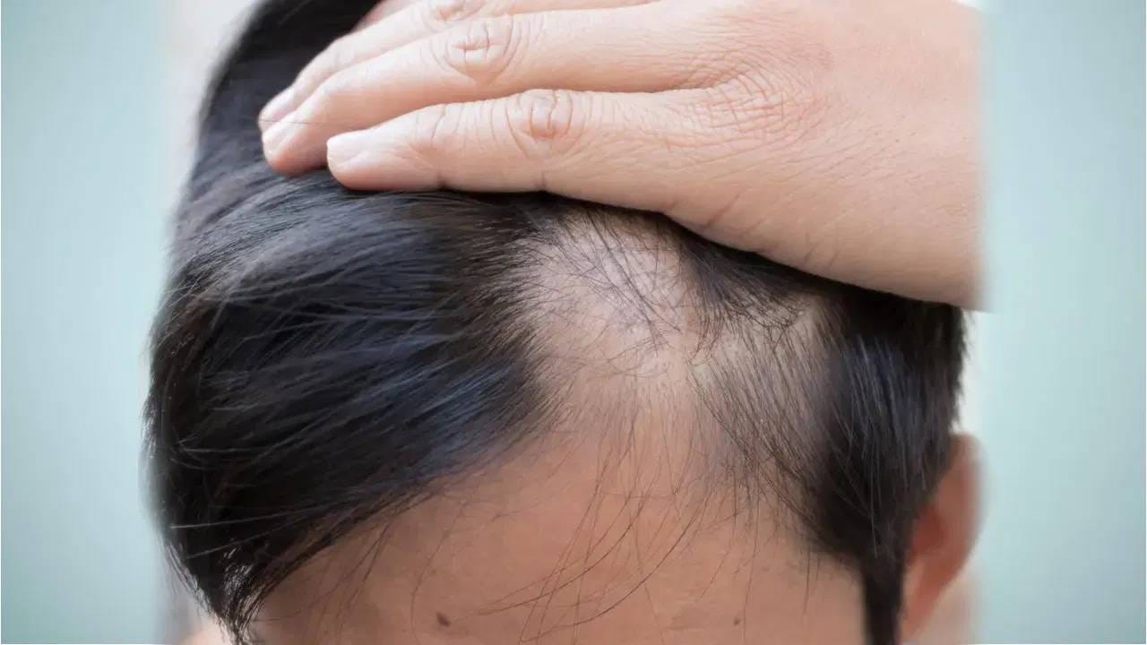  केस गळतीचा त्रास फक्त महिलांनाच नाही तर पुरूषांनाही मोठ्या प्रमाणात होतो. जर तुम्ही केस गळती आणि होणाऱ्या टक्कलमुळे त्रस्त असाल तर येथे घरगुती उपाय नक्की वाचा. 