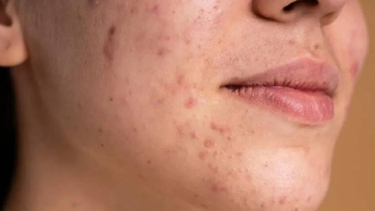 वारंवार वापरलेल्या तेलातील पदार्थ जर तुम्ही खात असाल तर ते आरोग्यासाठीच नाही तर त्वचेसाठी हानिकारक आहे. ज्यामुळे त्वचेच्या समस्या निर्माण होतात. 