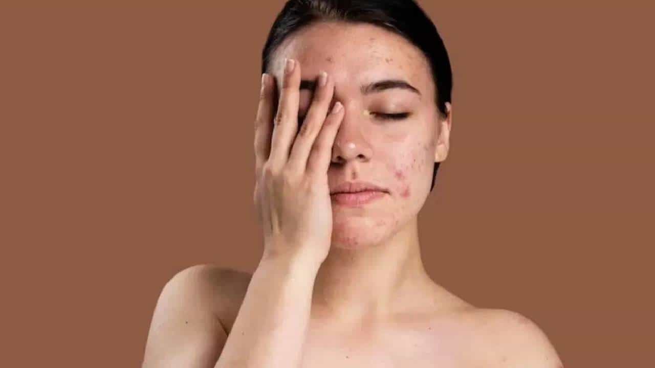चेहऱ्यावर पिंपल्स येणे, त्वचा कोरडी आणि लूज पडणे या समस्यांमध्ये अनेकजण त्रस्त असतात. जर तुम्ही देखील यामुळे त्रस्त असाल तर ही बातमी तुमच्यासाठी महत्वाची आहे.