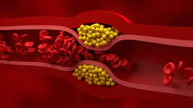 High Cholesterol Disease : उच्च कोलेस्ट्रॉलमुळे या गंभीर आजारांचा वाढतो धोका, या गोष्टी टाळा अन् वेळीच नियंत्रणात ठेवा!