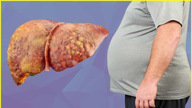 फॅटी लिव्हर ग्रेड 2 म्हणजे काय? कशी काळजी घ्यावी जाणून घ्या