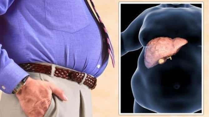 फॅटी लिव्हर ग्रेड-2 च्या निदानाचा अर्थ काय ? हा आजार किती धोकादायक ?