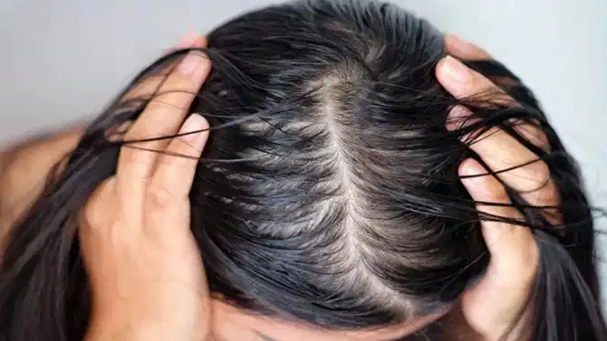 चिकट आणि तेलकट केसांपासून मिळेल सुटका, करा या होम रेमेडीज ट्राय