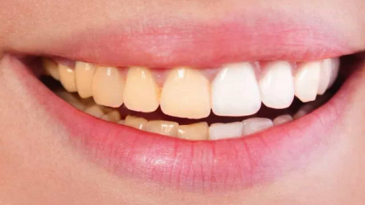 फक्त 10 रुपयांमध्ये दातावरील पिवळेपणा होईल दूर, त्वचा होणार पिंपल्स फ्री, जाणून घ्या