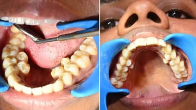 दातातील काळे खड्डे आणि कीड आता होईल छुमंतर, घरगुती रामबाण इलाज एकदा कराच