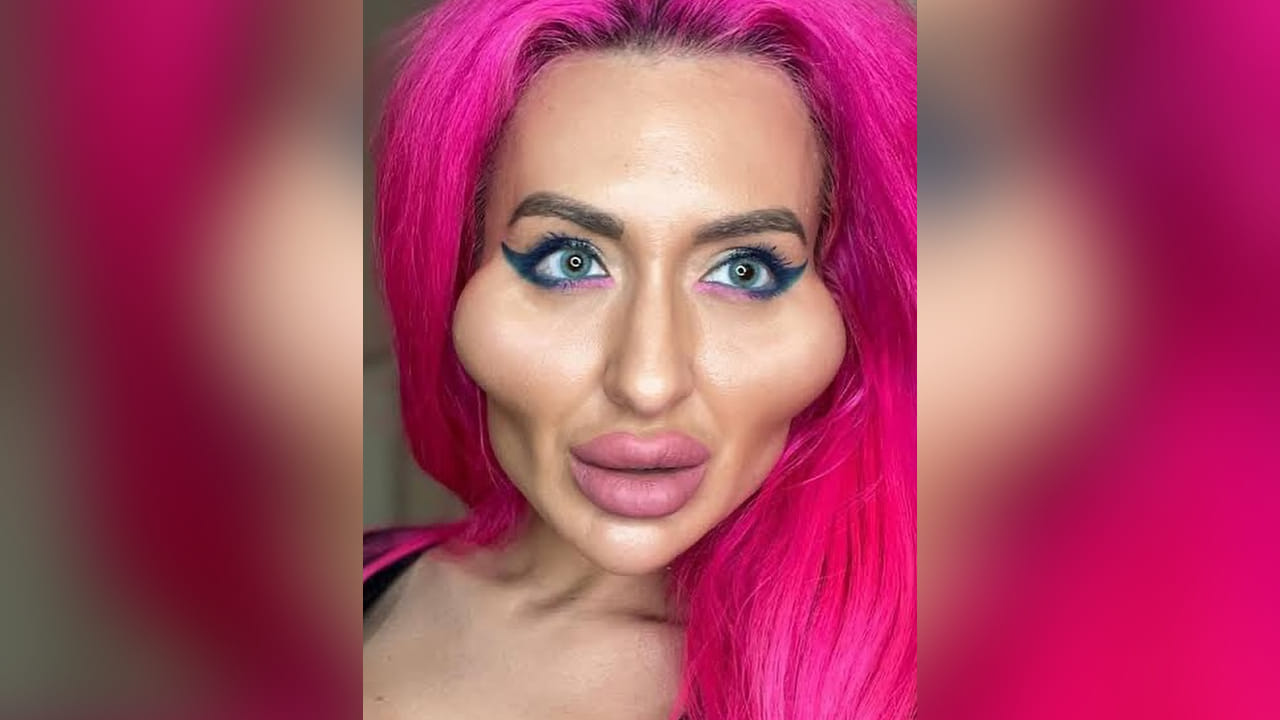 तिचा तो नैसर्गिक आणि साधा चेहरा आजच्या लुकशी तुलना करता ओळखूही येत नाही. अनास्तासियाने 26 व्या वर्षापासून कॉस्मेटिक ट्रीटमेंट घेण्यास सुरुवात केली. तिने हळूहळू गाल, जबडा आणि ओठांमध्ये फिलर्स केले. याशिवाय बोटॉक्स, ब्रेस्ट इम्प्लांटसह अनेक सर्जरी करून तिने आपला चेहराच बदलून टाकला.