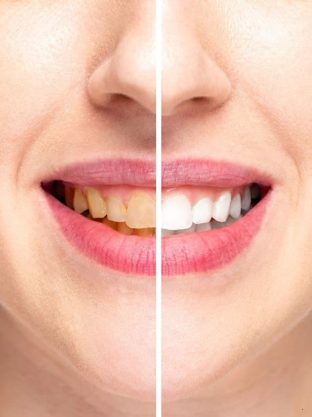 केळाच्या सालीने पांढरेशुभ्र होतील दात, कसे ते पाहा