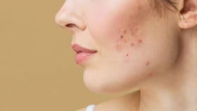 उन्हाळ्यात पुरळ, मुरूमांची समस्या सतावतेय? हे करून पहा...