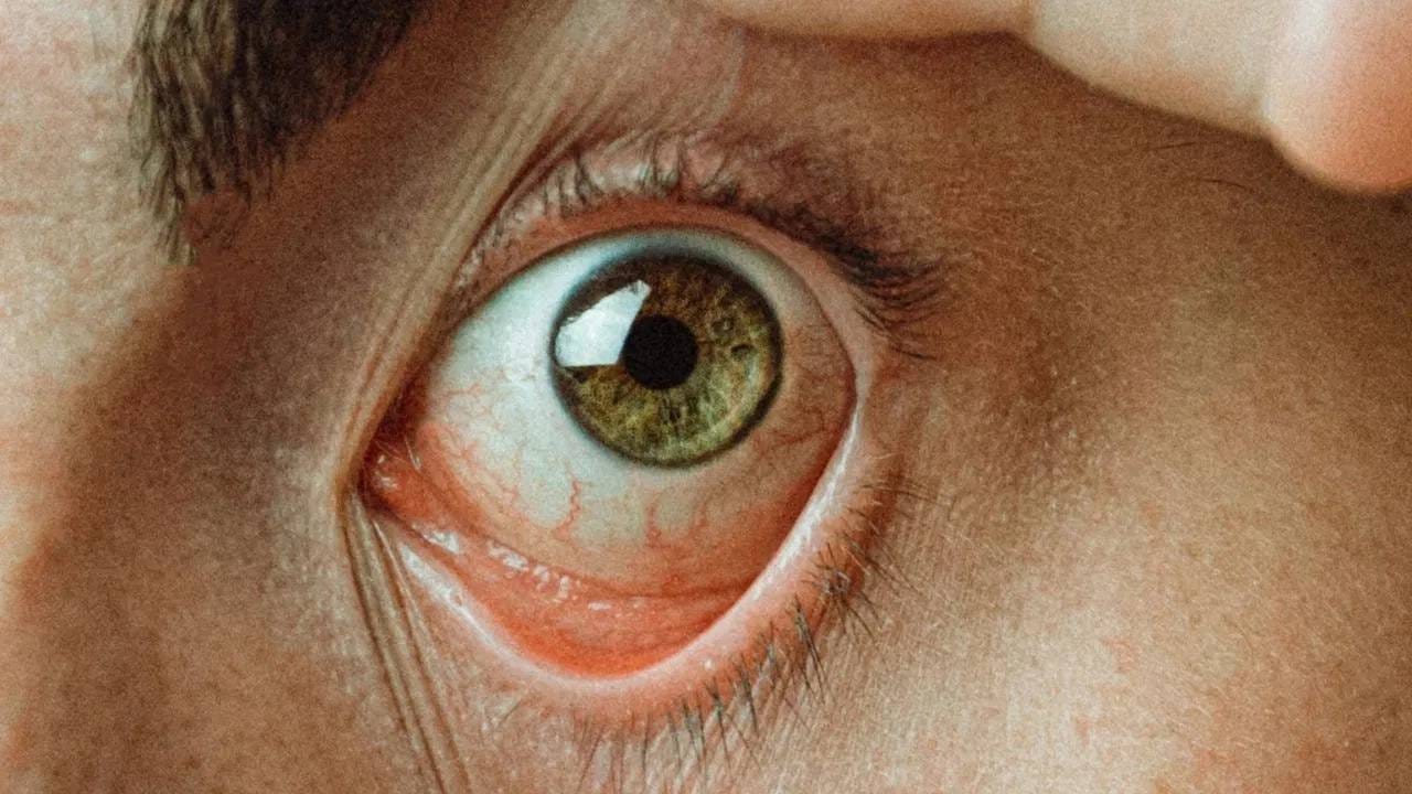 जर यकृत जास्तच खराब होऊ लागले तर त्याची लक्षणे आपल्या डोळ्यात दिसतात. थेट डोळ्यांवर परिणाम होतो. डोळे पिवळे होतात, ज्याला आपण कावीळ म्हणतो 