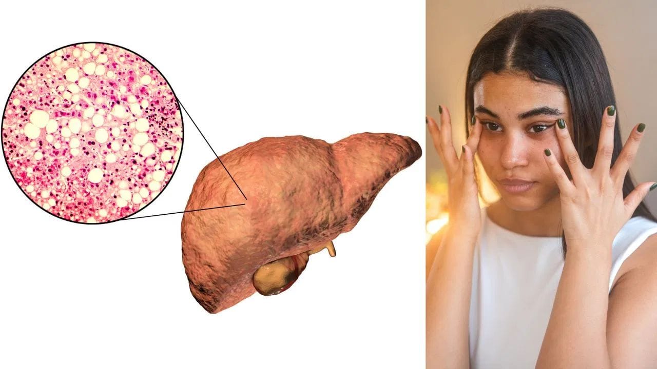  मिथक 3: लिव्हर ब्लड टेस्ट नॉर्मल असेल तर चिंतेची गरज नाही. - लिव्हरच्या टेस्टसाठी लोक SGPT टेस्ट करतात. या टेस्टचा रिपोर्ट नॉर्मल आला तर लिव्हर ठीक आहे असे नव्हे. अनेकदा सुरुवातीच्या स्टेजमध्ये लिव्हर एंजाईम (ALT, AST) सामान्य असतात. परंतू लिव्हरमध्ये फॅट जमायला सुरुवात होऊ शकते. त्यामुळे केवळ ब्लड टेस्टवर अवलंबून राहणे योग्य नाही. 