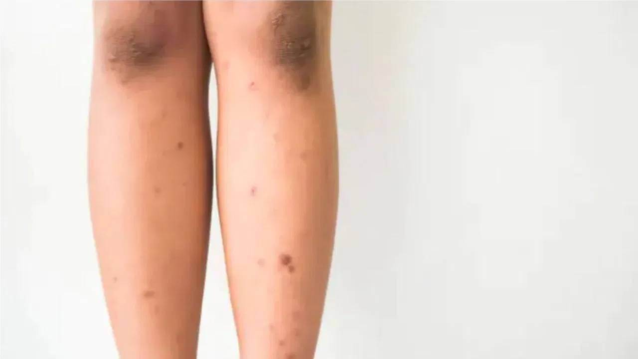 पायांवरील काळेपणा व कोरडेपणा दूर करण्यासाठी ‘या’ सोप्या घरगुती उपायांचा करा अवलंब