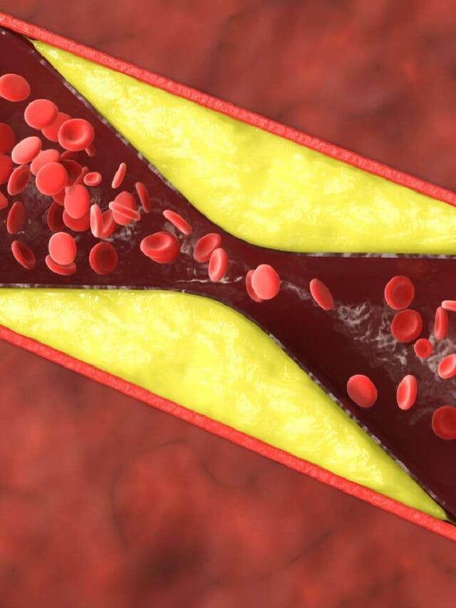 हाय कोलेस्ट्रॉलमध्ये हे अन्नपदार्थ धोकादायक असतात