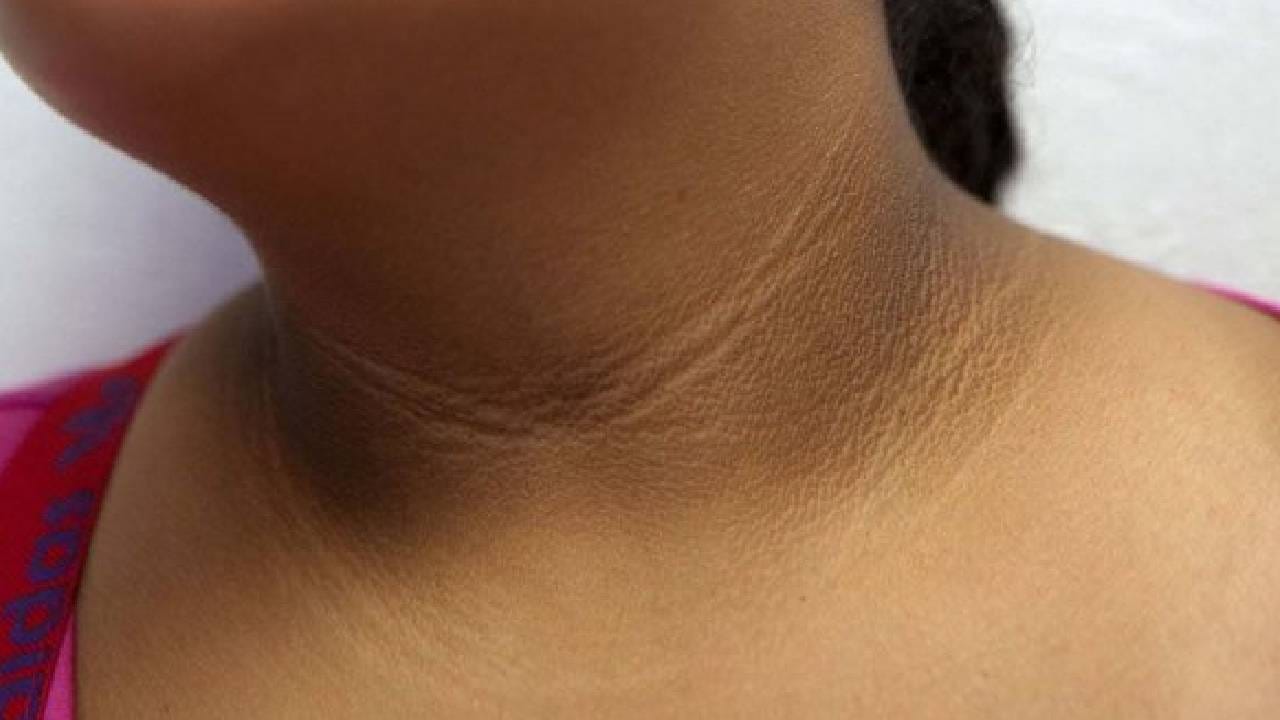 मधुमेह आजकाल सामान्य आजार बनला आहे. अनेक लोकांना मधुमेह झालेला कळतही नाही. ज्यावेळी जास्त त्रास सुरू होतो, त्यावेळी त्यांना कळते की, आपल्याला मधुमेहाची लागण झाली. 