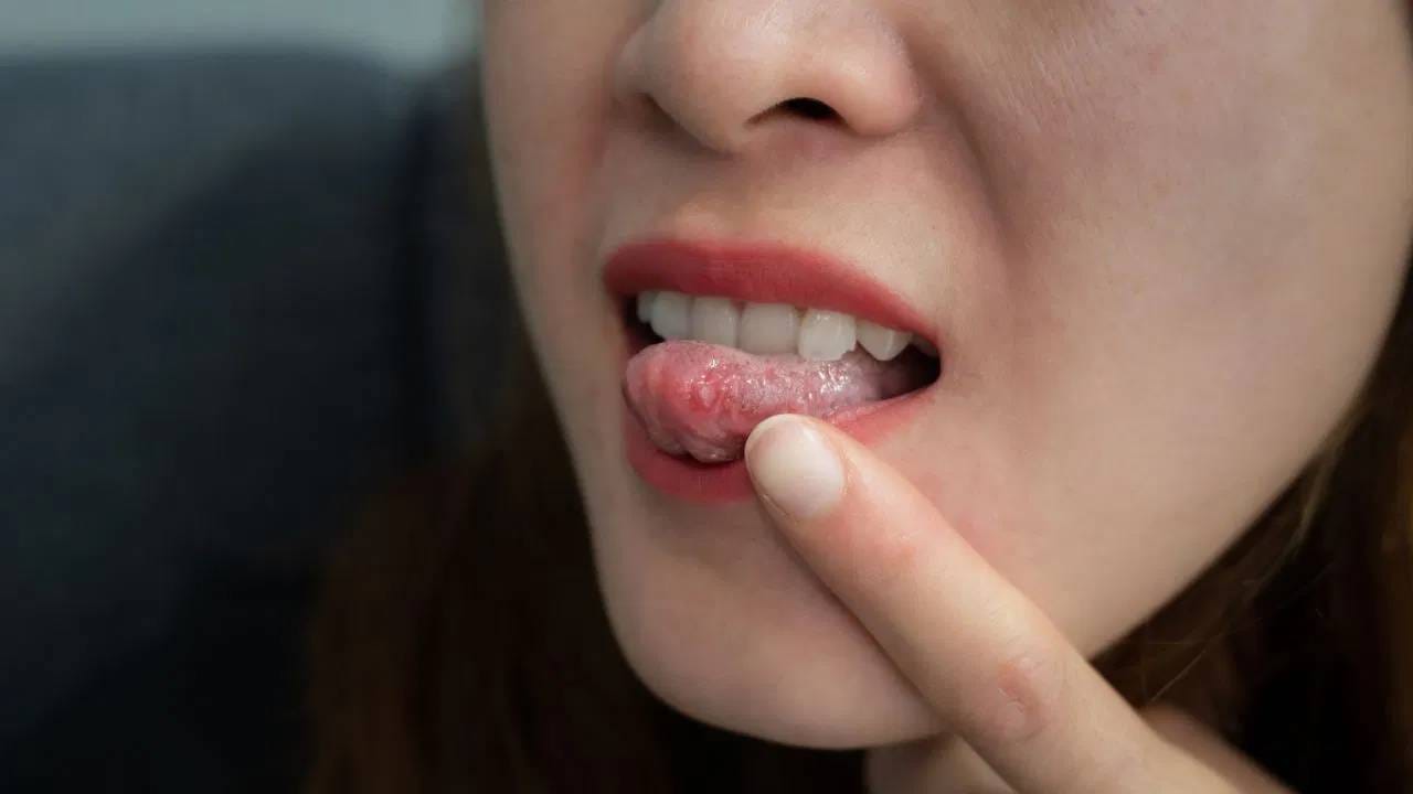 जिभेवर अल्सर कशामुळे होतं? कशी काळजी घ्यावी?