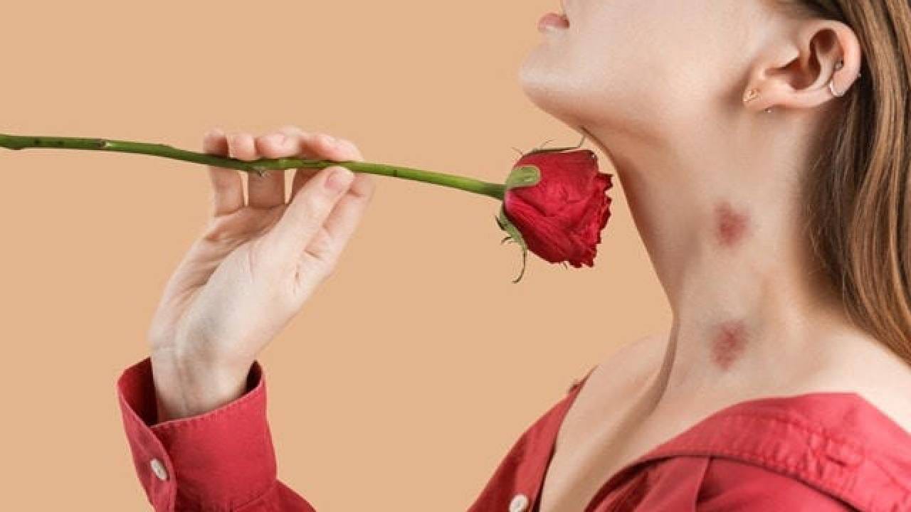 Love Bite ठरतो जीवघेणा? प्रेमीयुगलांसाठी धोका काय.. उपाय जाण