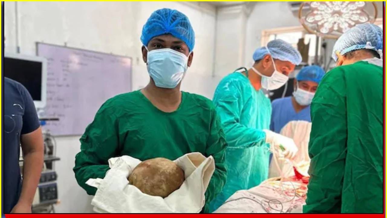 श्रीलंकेत 55 वर्षीय रुग्णाच्या पोटातून 3.1 किलोचा मुतखडा काढला
