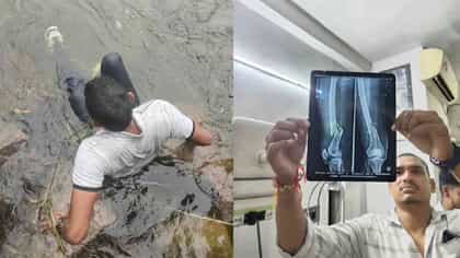 रिल साठी 30 फुटांवरून नदीत कुदला, पायाचा x-ray बघा....