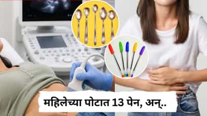 महिलेच्या पोटात 13 पेन, मेणबत्ती अन् लाकडी चमचे; डॉक्टरही अवाक....