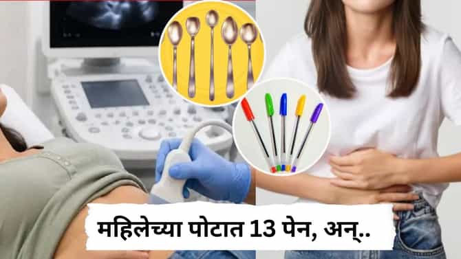 Woman Swallows 13 Pens : महिलेच्या पोटात 13 पेन, मेणबत्ती अन् लाकडी चमचे; डॉक्टरही अवाक, नेमकं काय घडलं?
