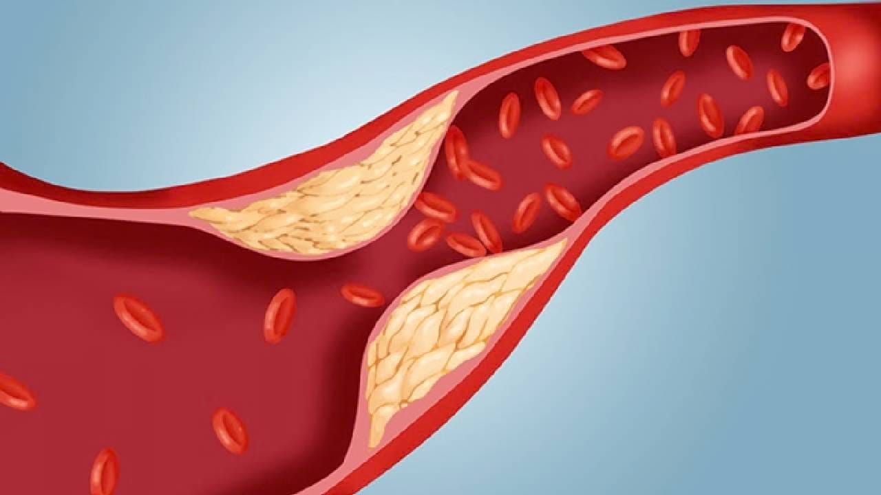 पायांमध्ये दुखणे आणि सुन्नपणा : शरीरात कोलेस्ट्रॉल जास्त झाल्यास पायांमध्ये दुखणे, सुन्न होणे आणि सतत थकवा जाणवणे या समस्या उद्भवू शकतात. (Disclaimer: वरच्या लेखातील माहिती ही प्राथमिक स्वरुपाची आहे. आम्ही या माहितीची पुष्टी करत नाही किंवा समर्थनही देत नाही.)