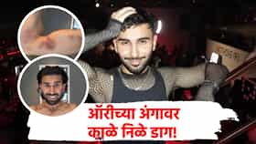 Orry Injured : ऑरीचं शरीर काळंनिळं पडलं, संपूर्ण अंगावर जखमा, केले धक्कादायक फोटो शेअर; म्हणाला स्वत:ला मृत्यूसमोर...