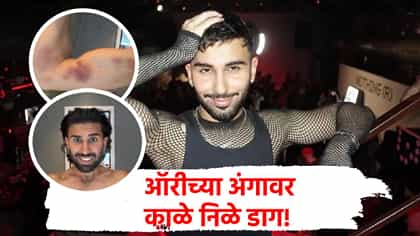 ऑरीचं शरीर काळंनिळं पडलं, संपूर्ण अंगावर जखमा, केले फोटो शेअर.